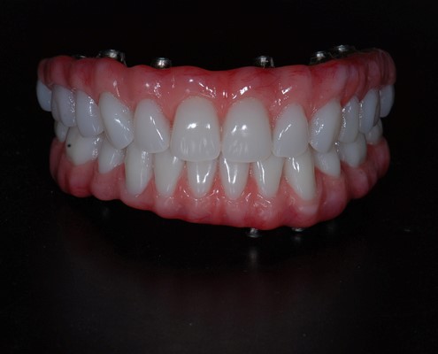 New Dentures Before And After Pictures San Ysidro CA 92173